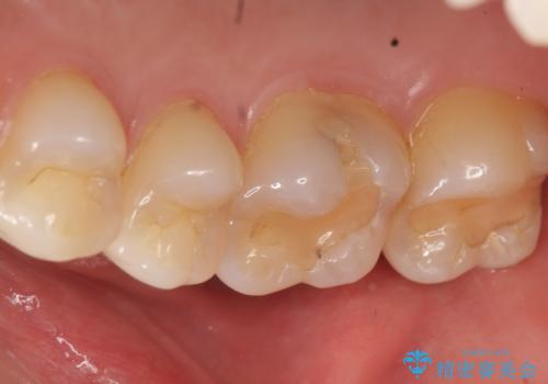 奥歯にフロスを通すと臭い 30代女性の治療前