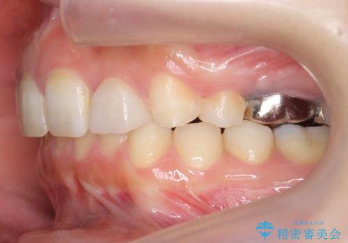 出っ歯を治したい 過蓋咬合の治療後