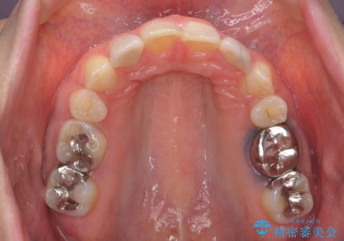 出っ歯を治したい 過蓋咬合の治療後