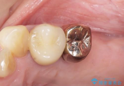 奥歯の違和感 再根管治療 40代女性の治療前