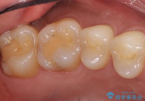 奥歯にフロスを通すと臭い 30代女性の治療前