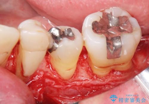 歯周病を治す　再生療法　50代男性の治療中