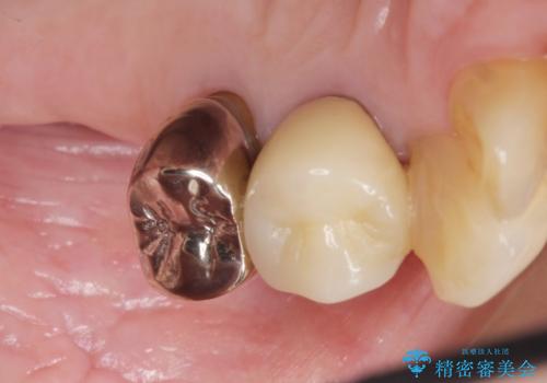 奥歯の違和感 再根管治療 40代女性の治療前