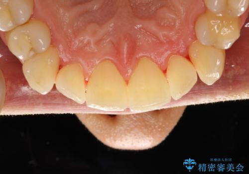 歯磨き中に血が出る PMTCで歯石除去の治療後