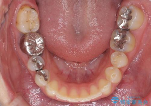 出っ歯を治したい　過蓋咬合の治療後