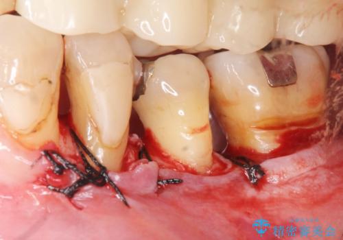 歯周病を治す 再生療法 50代男性の治療中