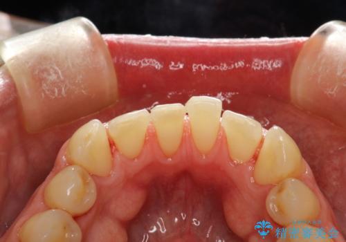 歯磨き中に血が出る　PMTCで歯石除去の治療後