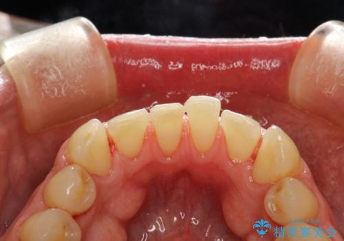 歯磨き中に血が出る　PMTCで歯石除去の症例 治療後