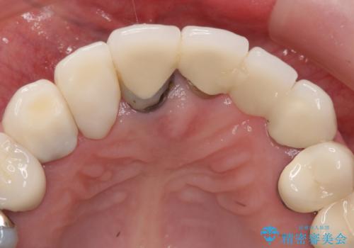 前歯のブリッジの下が虫歯　ブリッジのやりかえの治療前