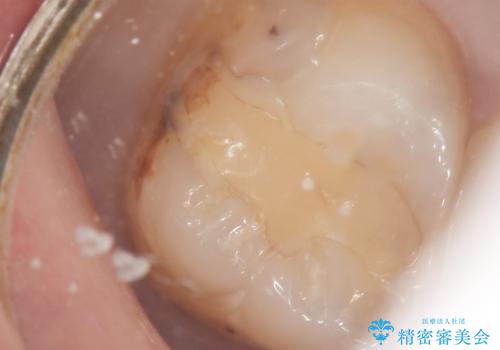 奥歯にフロスを通すと臭い 30代女性の治療中