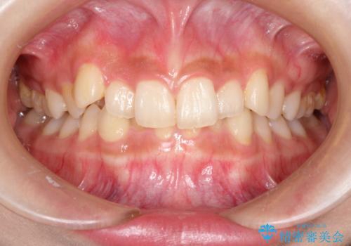 インビザラインを使用した深いかみ合わせの矯正の治療前