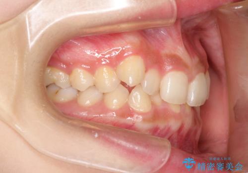 インビザラインを使用した深いかみ合わせの矯正の治療前