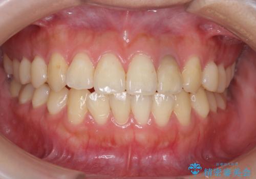 オフィスホワイトニングで歯を白く!の治療前