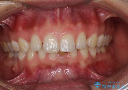 【空隙歯列】ワイヤー矯正で短期間に治療を終えたいの治療前