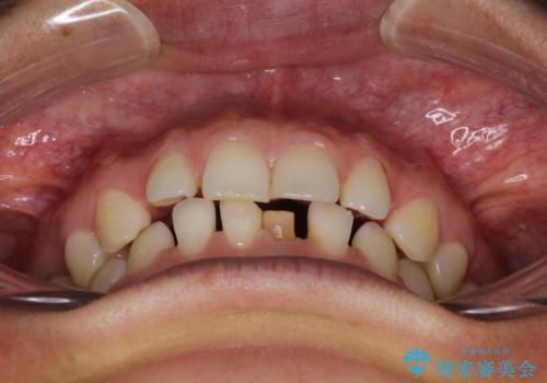 【空隙歯列】ワイヤー矯正で短期間に治療を終えたいの治療前