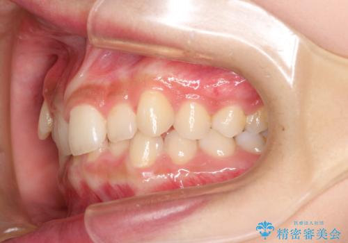 インビザラインを使用した深いかみ合わせの矯正の治療前
