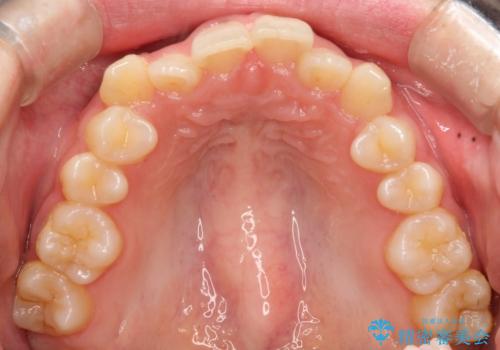 インビザラインを使用した深いかみ合わせの矯正の治療前