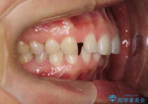 【空隙歯列】ワイヤー矯正で短期間に治療を終えたいの治療前