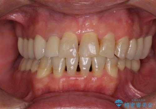 歯列不正と歯周病 総合歯科治療による全顎治療の症例 治療後