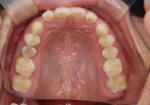 【空隙歯列】ワイヤー矯正で短期間に治療を終えたいの治療前