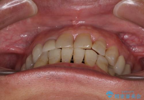 歯列不正と歯周病 総合歯科治療による全顎治療の治療後