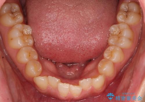 インビザラインを使用した深いかみ合わせの矯正の治療前