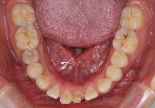 【空隙歯列】ワイヤー矯正で短期間に治療を終えたいの治療前