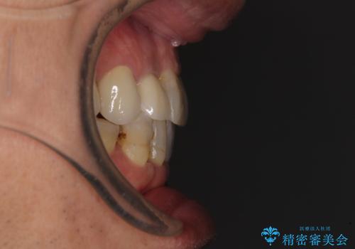 歯列不正と歯周病 総合歯科治療による全顎治療の治療後