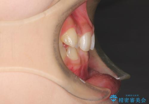 インビザラインを使用した深いかみ合わせの矯正の治療前