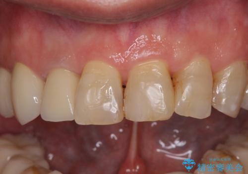 歯列不正と歯周病 総合歯科治療による全顎治療の治療後