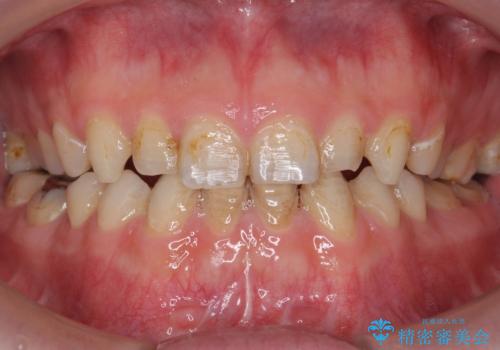 Kポップアイドルのような歯にしたい! 20代男性