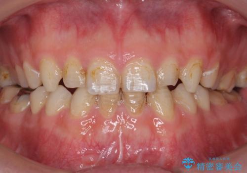 Kポップアイドルのような歯にしたい! 20代男性の治療前