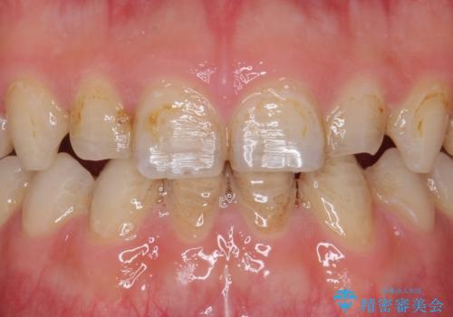 Kポップアイドルのような歯にしたい! 20代男性の治療前