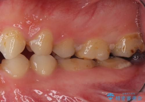 Kポップアイドルのような歯にしたい! 20代男性の治療前