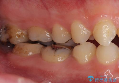 Kポップアイドルのような歯にしたい! 20代男性の治療前