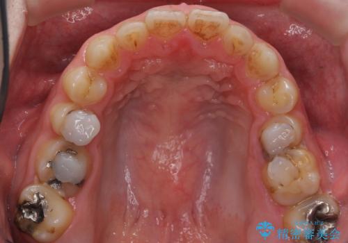 Kポップアイドルのような歯にしたい! 20代男性の治療前