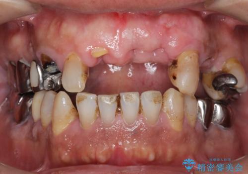 交通事故で前歯が折れた マグネットデンチャー 50代男性