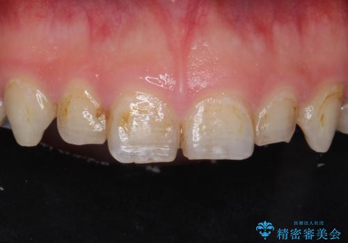 Kポップアイドルのような歯にしたい! 20代男性の症例 治療前