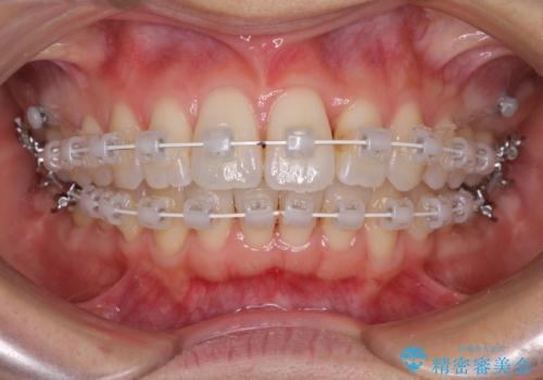 短期間で仕上げたい ワイヤーでの非抜歯矯正の治療中