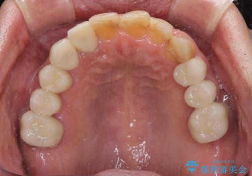 歯列不正と歯周病 総合歯科治療による全顎治療の治療後