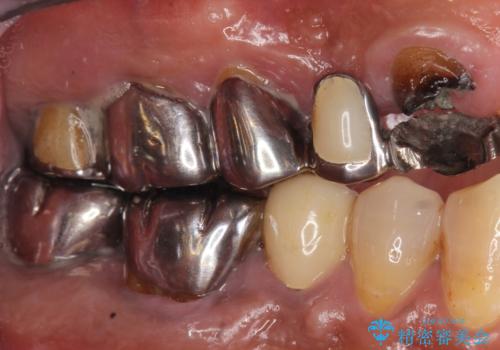 交通事故で前歯が折れた マグネットデンチャー 50代男性の治療前