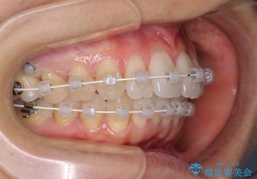 短期間で仕上げたい ワイヤーでの非抜歯矯正の治療中