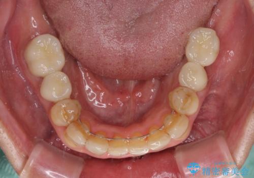 歯列不正と歯周病 総合歯科治療による全顎治療の治療後
