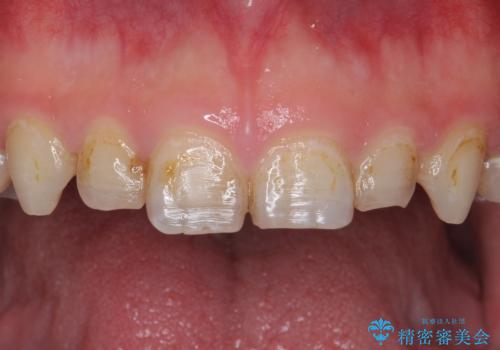 Kポップアイドルのような歯にしたい! 20代男性の治療前