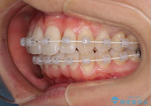 短期間で仕上げたい ワイヤーでの非抜歯矯正の治療中