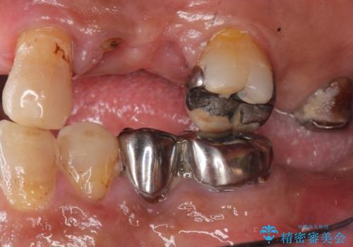 交通事故で前歯が折れた マグネットデンチャー 50代男性の治療前