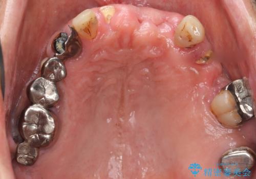 交通事故で前歯が折れた マグネットデンチャー 50代男性の治療前