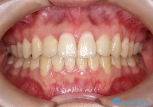前歯が前後反対にかんでいる　インビザラインによる矯正の症例 治療後