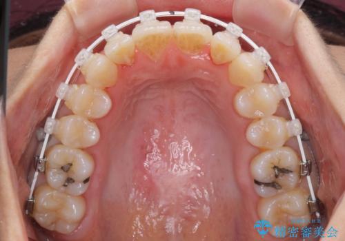 短期間で仕上げたい ワイヤーでの非抜歯矯正の治療中
