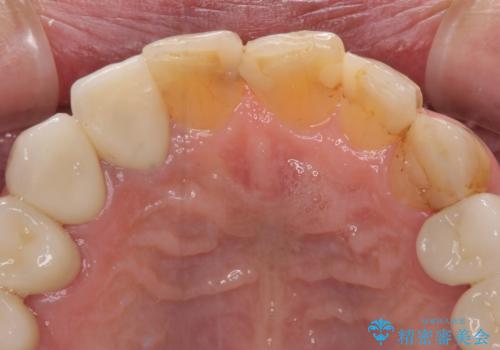 歯列不正と歯周病 総合歯科治療による全顎治療の治療後